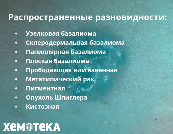Разновидности базалиомы