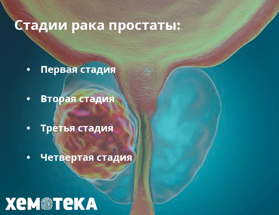 стадии рака