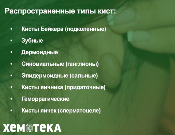 Типы кист